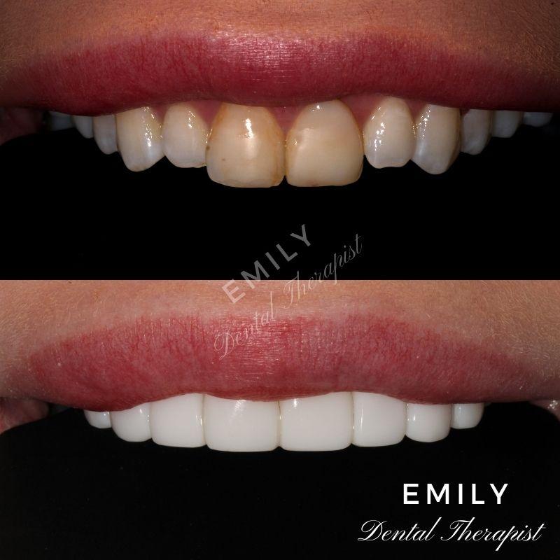 Composite veneers