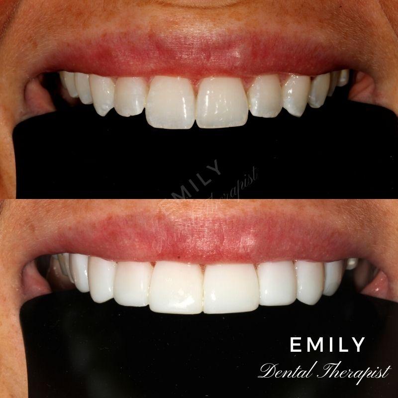 Composite veneers