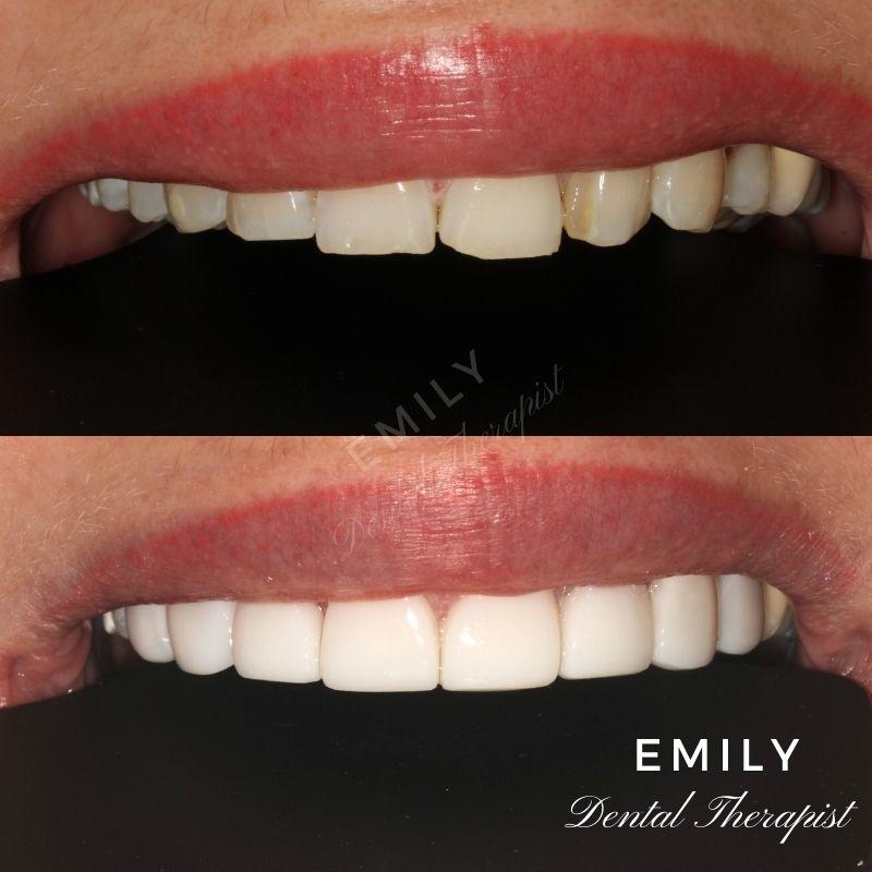 Composite veneers